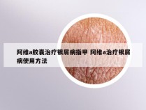 阿维a胶囊治疗银屑病指甲 阿维a治疗银屑病使用方法