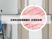 泛发性白斑初期图片 泛发型白斑