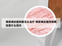 银屑病去医院都怎么治疗 银屑病去医院需要检查什么地方