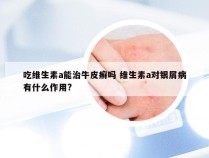 吃维生素a能治牛皮癣吗 维生素a对银屑病有什么作用?