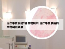 治疗牛皮癣的2种生物制剂 治疗牛皮肤癣的生物制剂效果