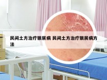 民间土方治疗银屑病 民间土方治疗银屑病方法