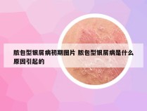 脓包型银屑病初期图片 脓包型银屑病是什么原因引起的