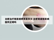 合肥治疗银屑病费用是多少 合肥银康银屑病医院正规吗