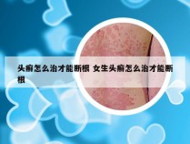 头癣怎么治才能断根 女生头癣怎么治才能断根