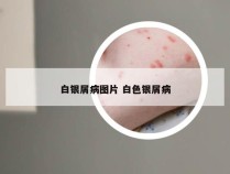 白银屑病图片 白色银屑病