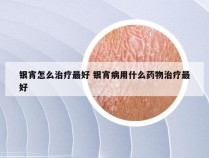 银宵怎么治疗最好 银宵病用什么药物治疗最好