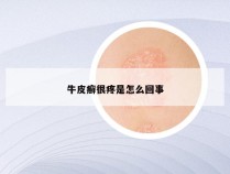 牛皮癣很疼是怎么回事