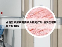 点滴型银屑病需要紫外线光疗吗 点滴型银屑病光疗好吗