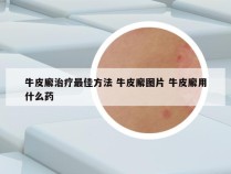 牛皮廨治疗最佳方法 牛皮廨图片 牛皮廨用什么药