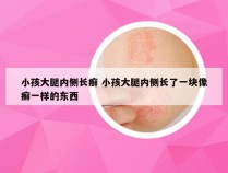 小孩大腿内侧长癣 小孩大腿内侧长了一块像癣一样的东西