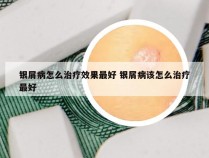 银屑病怎么治疗效果最好 银屑病该怎么治疗最好