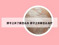 脖子上长了藓怎么办 脖子上长藓怎么治疗