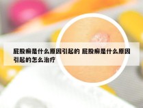 屁股癣是什么原因引起的 屁股癣是什么原因引起的怎么治疗