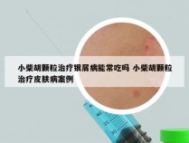 小柴胡颗粒治疗银屑病能常吃吗 小柴胡颗粒治疗皮肤病案例