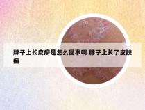 脖子上长皮癣是怎么回事啊 脖子上长了皮肤癣