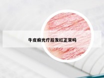 牛皮癣光疗后发红正常吗