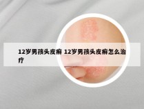 12岁男孩头皮癣 12岁男孩头皮癣怎么治疗