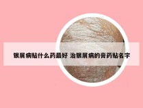 银屑病贴什么药最好 治银屑病的膏药贴名字