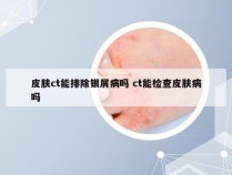 皮肤ct能排除银屑病吗 ct能检查皮肤病吗