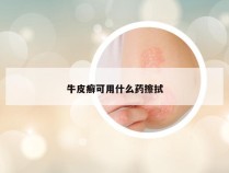 牛皮癣可用什么药擦拭