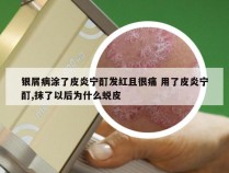 银屑病涂了皮炎宁酊发红且很痛 用了皮炎宁酊,抹了以后为什么蜕皮