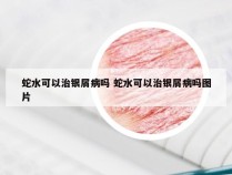 蛇水可以治银屑病吗 蛇水可以治银屑病吗图片