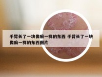 手臂长了一块像癣一样的东西 手臂长了一块像癣一样的东西图片