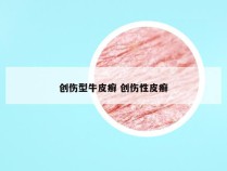 创伤型牛皮癣 创伤性皮癣