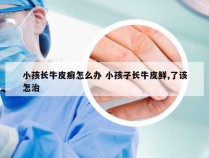 小孩长牛皮癣怎么办 小孩子长牛皮鲜,了该怎治