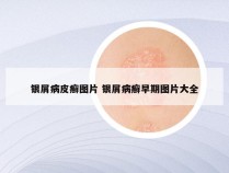 银屑病皮癣图片 银屑病癣早期图片大全