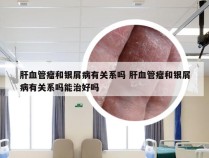 肝血管瘤和银屑病有关系吗 肝血管瘤和银屑病有关系吗能治好吗