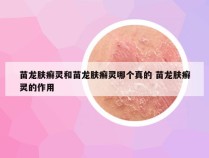 苗龙肤癣灵和苗龙肤癣灵哪个真的 苗龙肤癣灵的作用