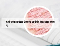 儿童副银屑病会变胖吗 儿童初期副银屑病照片