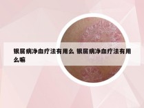 银屑病净血疗法有用么 银屑病净血疗法有用么嘛