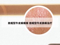 脓疱型牛皮癣瘙痒 脓疱型牛皮肤癣治疗