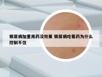 银屑病加重用药没效果 银屑病吃着药为什么控制不住