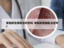 掌跖脓包病有治好的吗 掌跖脓疱病能治愈吗?