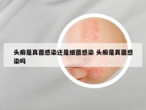 头癣是真菌感染还是细菌感染 头癣是真菌感染吗