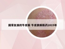 国家批准的牛皮癣 牛皮肤癣新药2019年