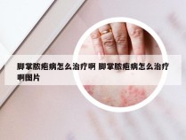 脚掌脓疱病怎么治疗啊 脚掌脓疱病怎么治疗啊图片