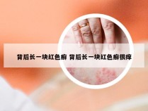 背后长一块红色癣 背后长一块红色癣很痒