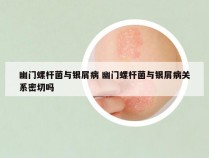 幽门螺杆菌与银屑病 幽门螺杆菌与银屑病关系密切吗