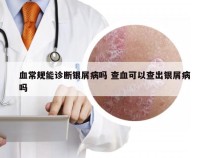 血常规能诊断银屑病吗 查血可以查出银屑病吗