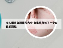 女人眼角白斑图片大全 女生眼角长了一个白色的颗粒