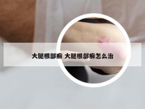 大腿根部癣 大腿根部癣怎么治