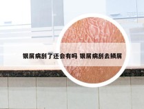 银屑病刮了还会有吗 银屑病刮去鳞屑