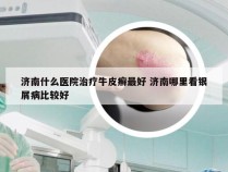 济南什么医院治疗牛皮癣最好 济南哪里看银屑病比较好