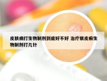 皮肤病打生物制剂到底好不好 治疗银皮癣生物制剂打几针