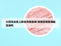 小孩洗浴患上脓包性银屑病 脓疱型银屑病能洗澡吗